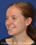 Otoplasty (Ear Re-Shaping Surgery) - Case 3134 - After