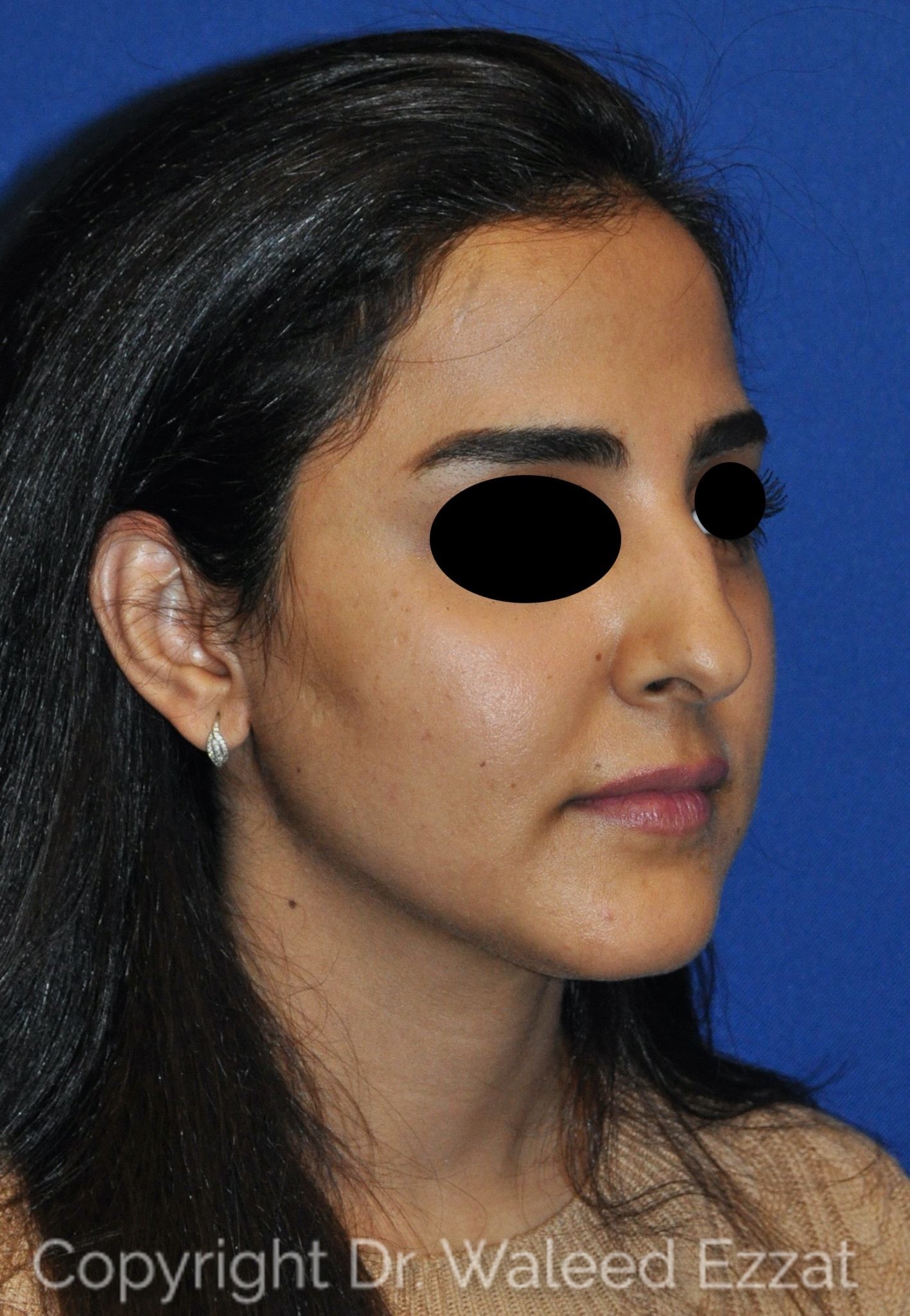 Mediterranean/Middle Eastern Rhinoplasty Patient Photo - Case 19 - before view-1