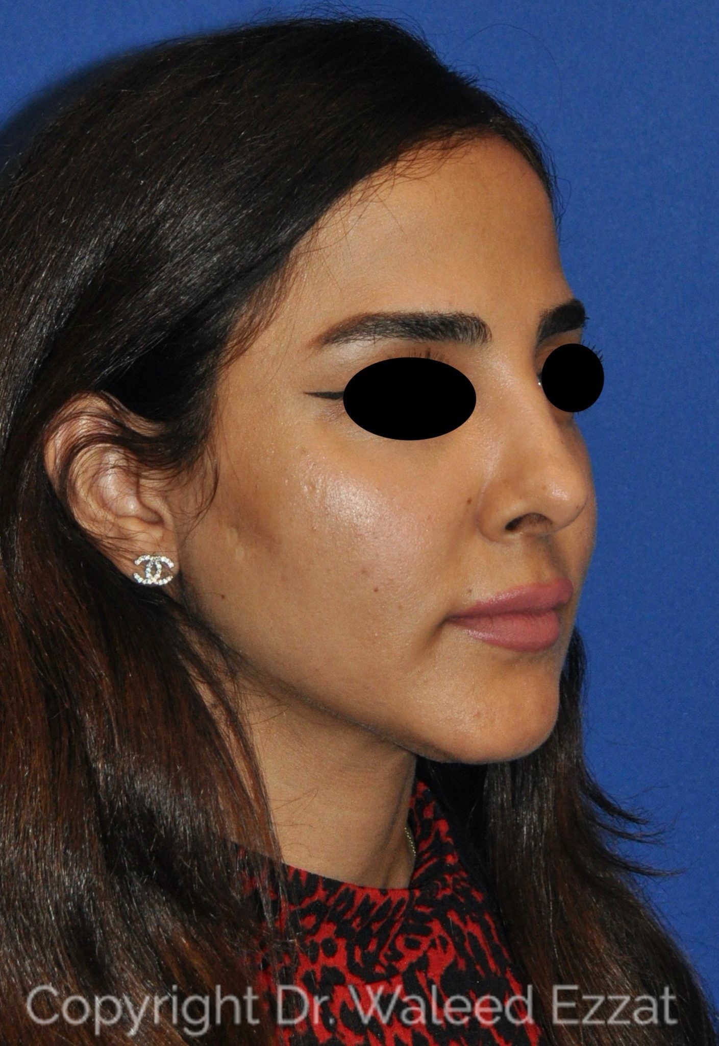 Mediterranean/Middle Eastern Rhinoplasty Patient Photo - Case 19 - after view-1