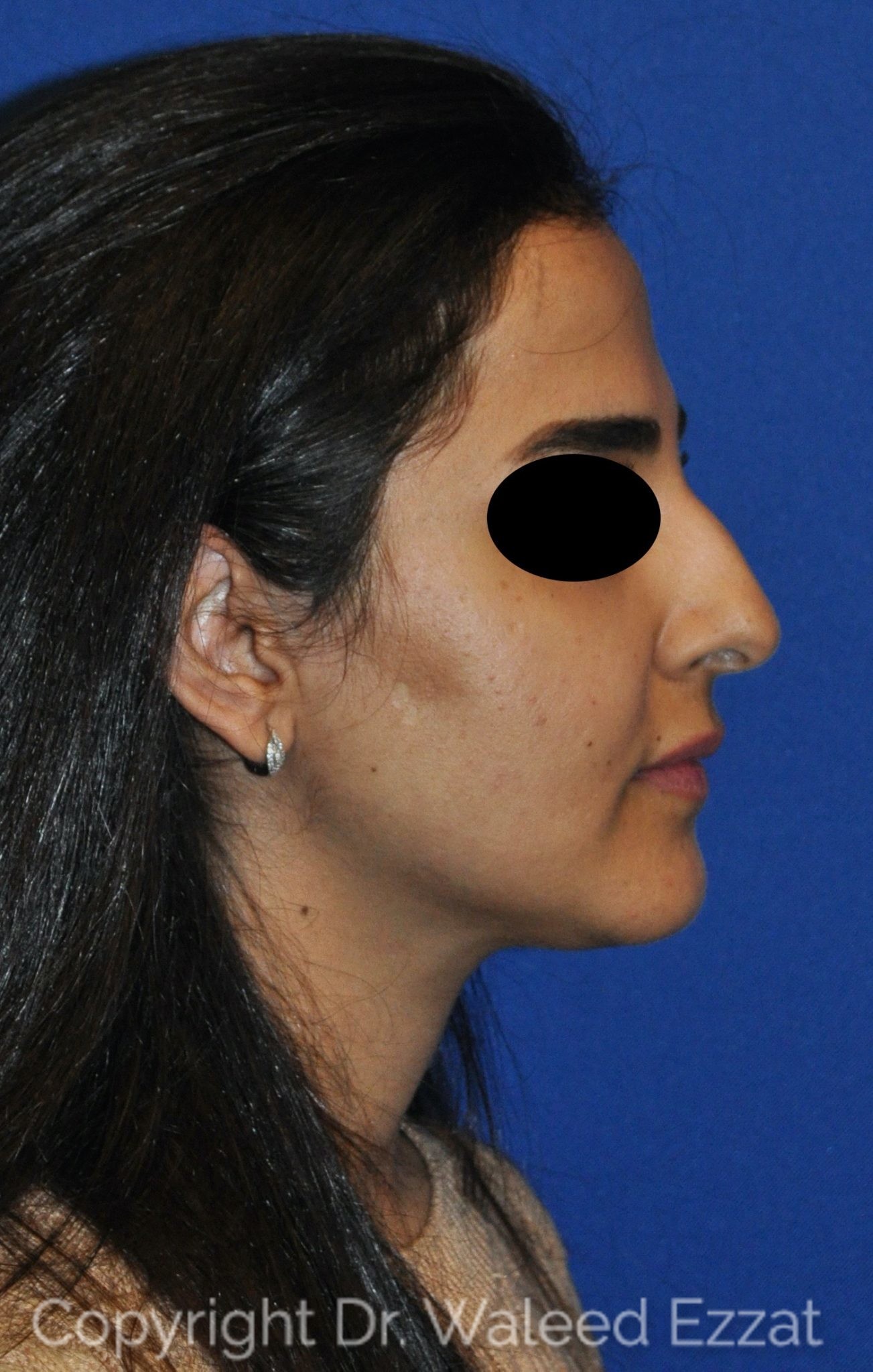 Mediterranean/Middle Eastern Rhinoplasty Patient Photo - Case 19 - before view-