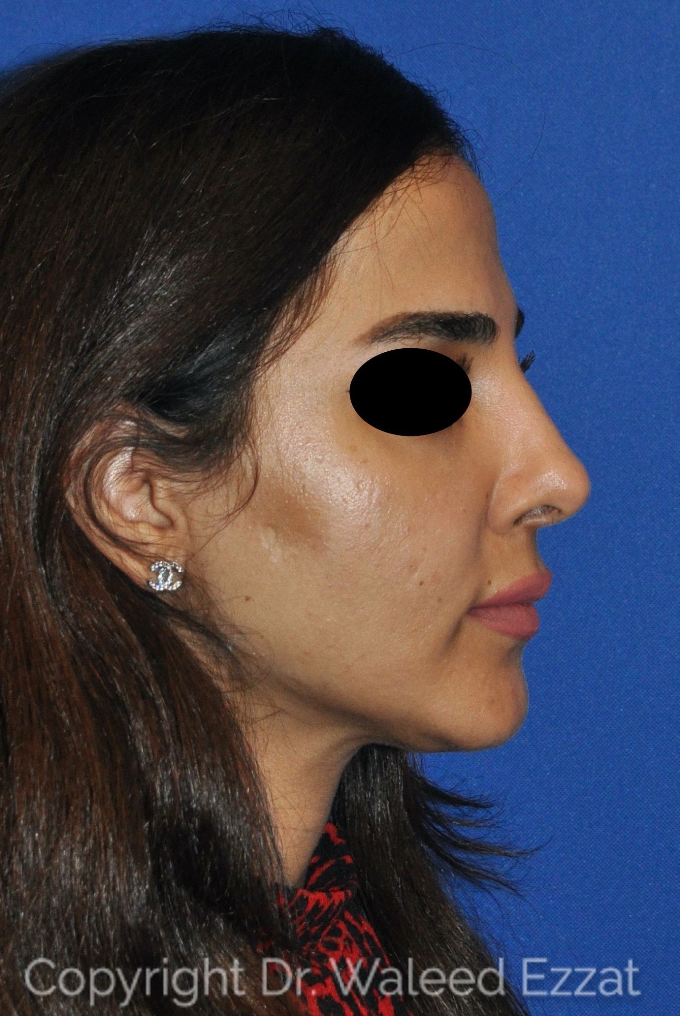 Mediterranean/Middle Eastern Rhinoplasty Patient Photo - Case 19 - after view-0