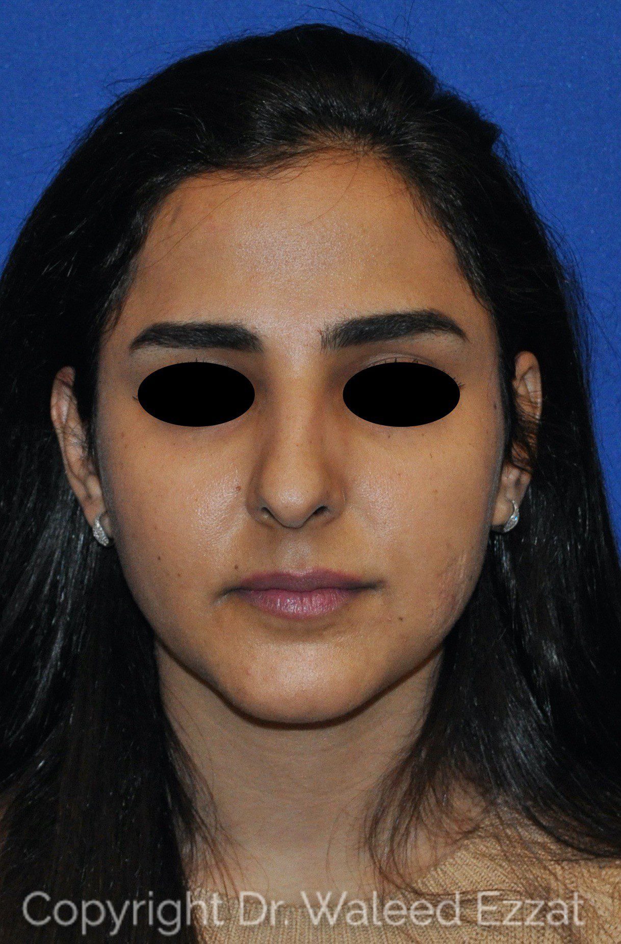 Mediterranean/Middle Eastern Rhinoplasty Patient Photo - Case 19 - before view-2