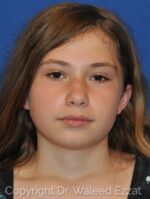 Facial Reconstructive Surgery - Case 4501 - Before