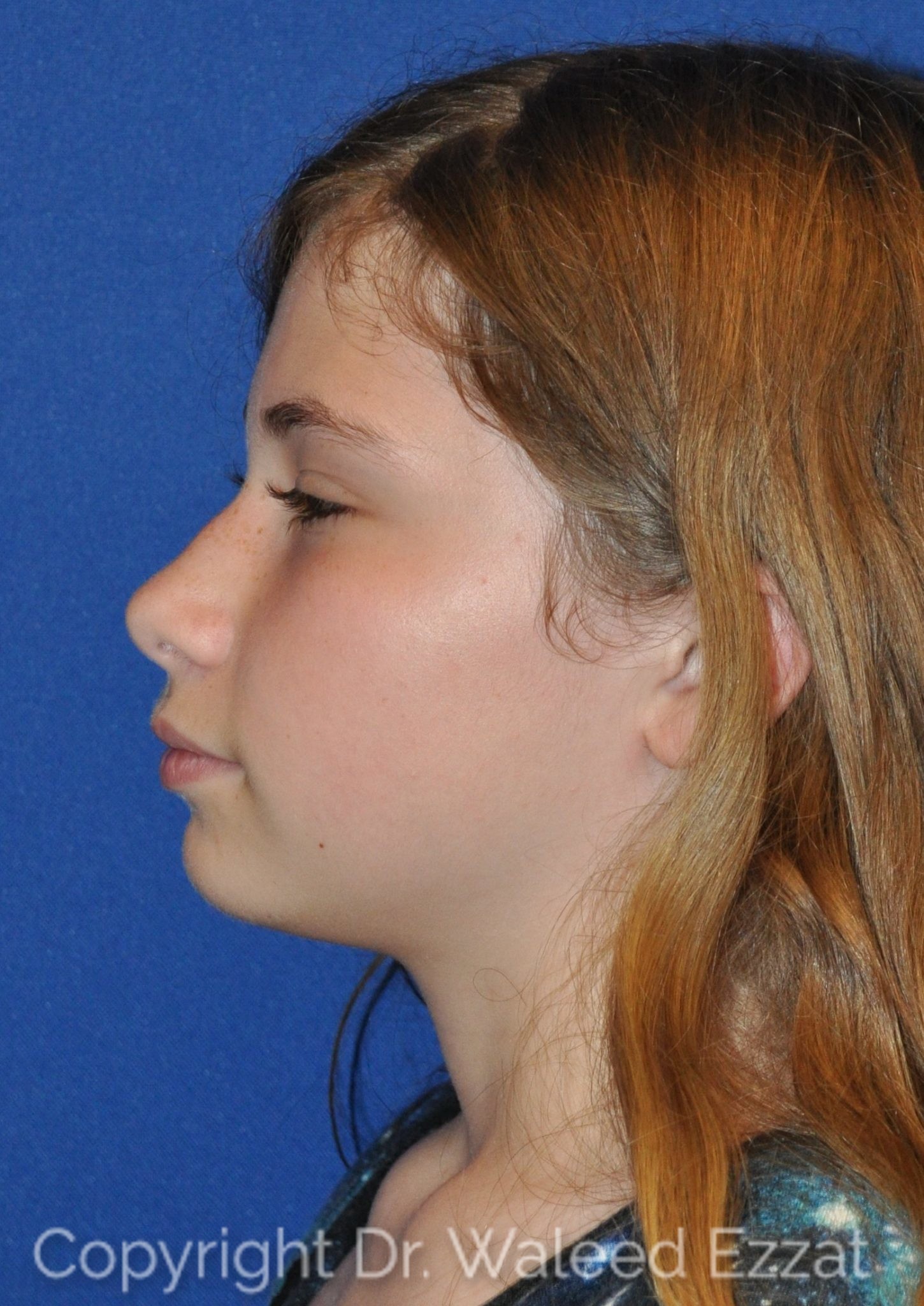 Facial Reconstructive Surgery Patient Photo - Case 4501 - before view-1