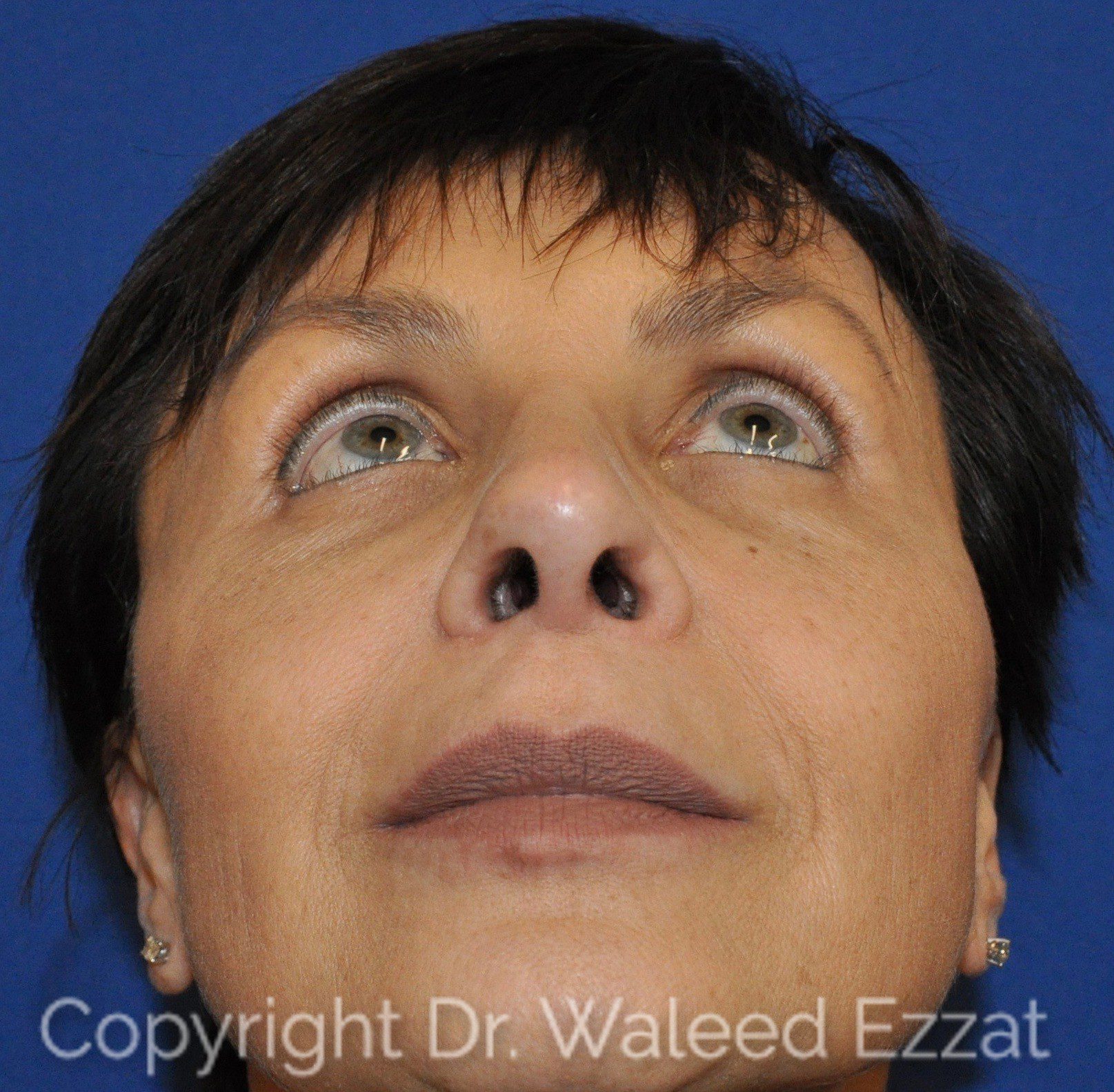 Caucasian/European Rhinoplasty Patient Photo - Case 18 - after view-2