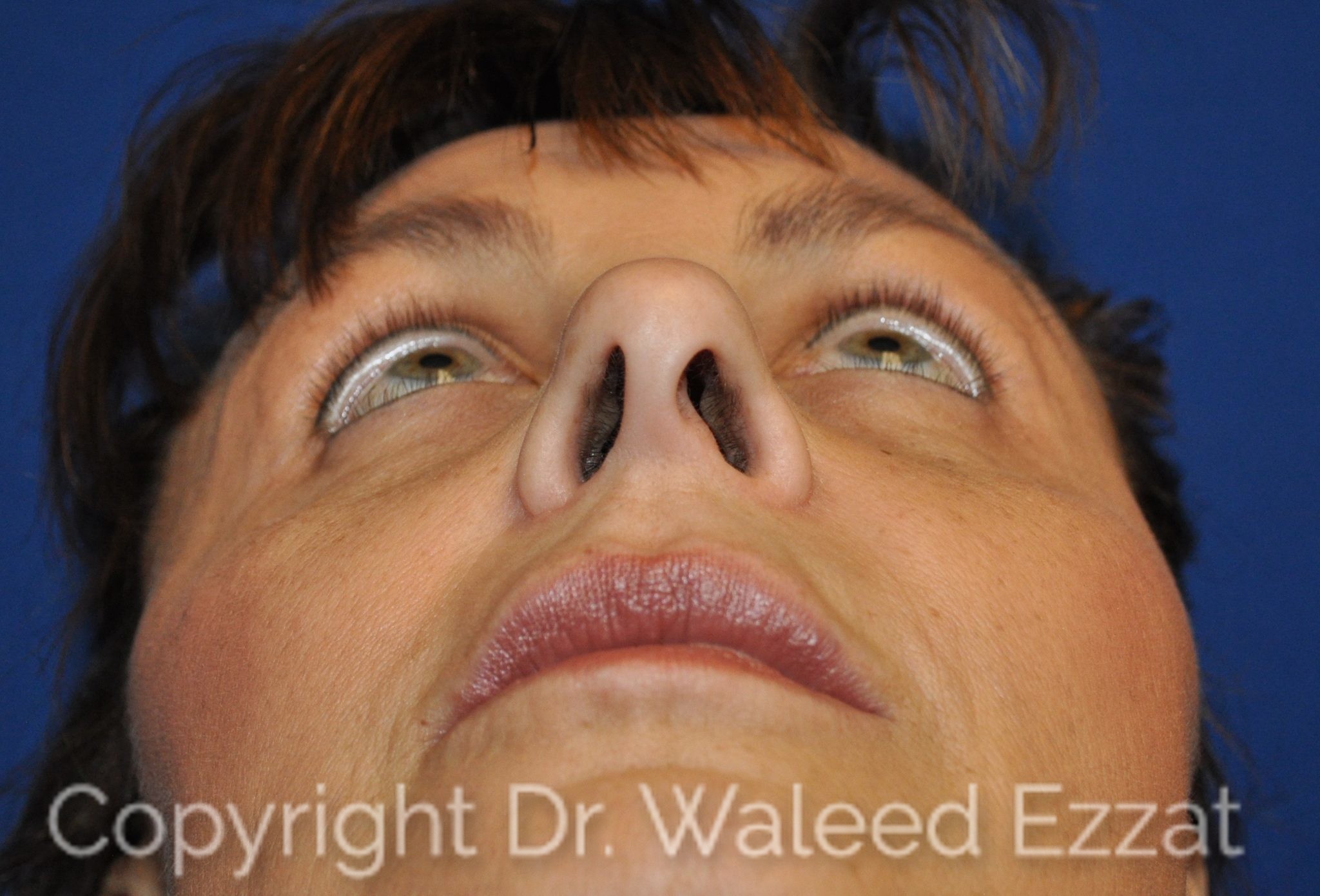Caucasian/European Rhinoplasty Patient Photo - Case 18 - before view-2