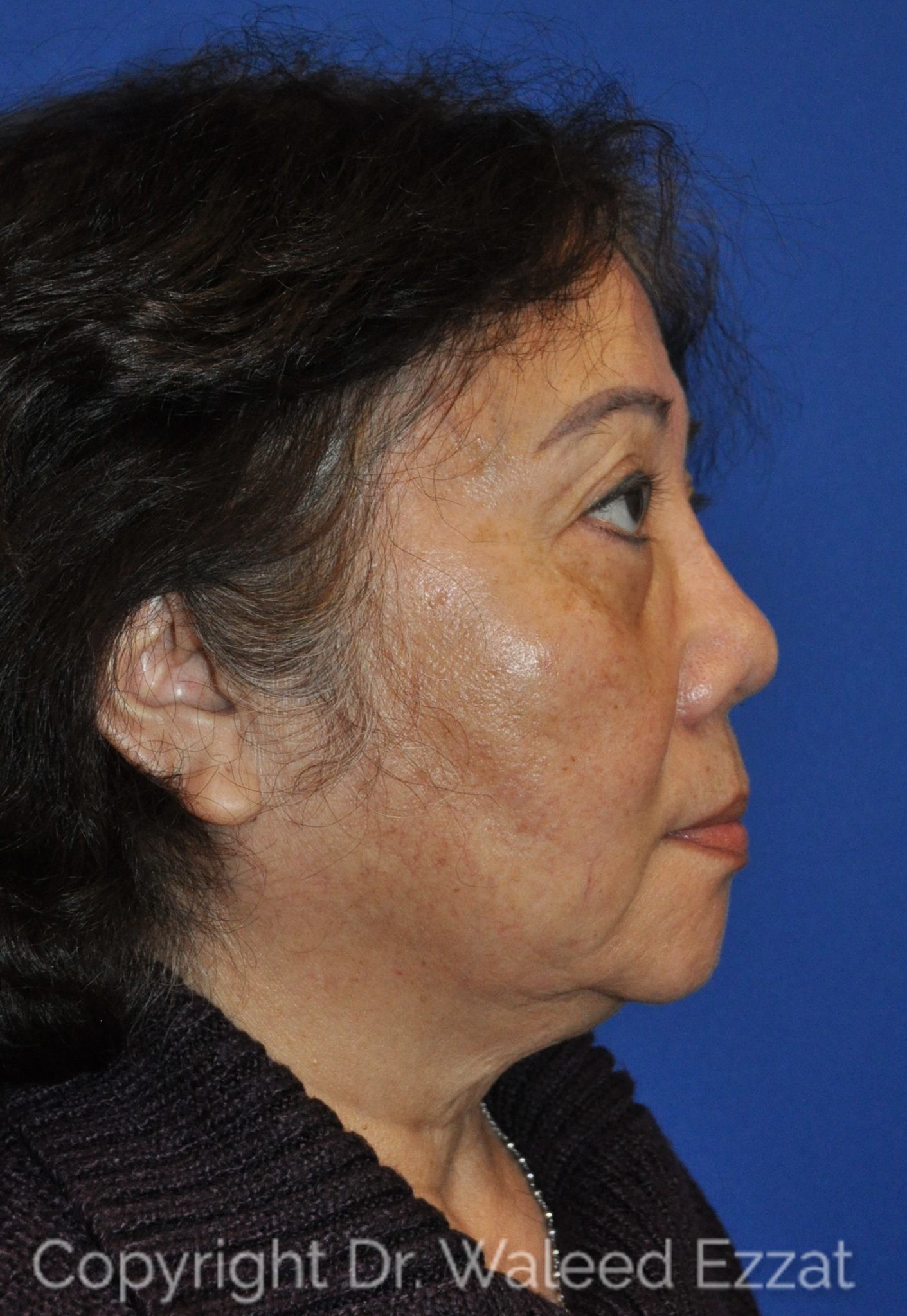 East Asian Rhinoplasty Patient Photo - Case 950 - after view-0