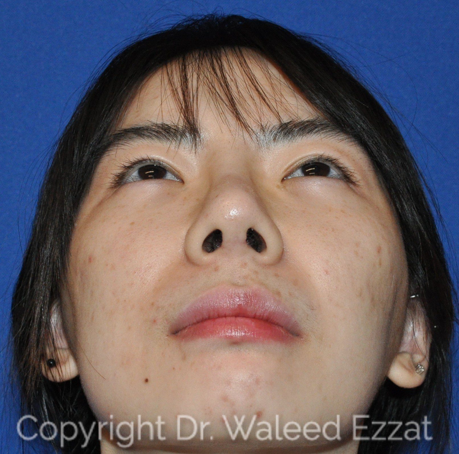 East Asian Rhinoplasty Patient Photo - Case 951 - after view-2