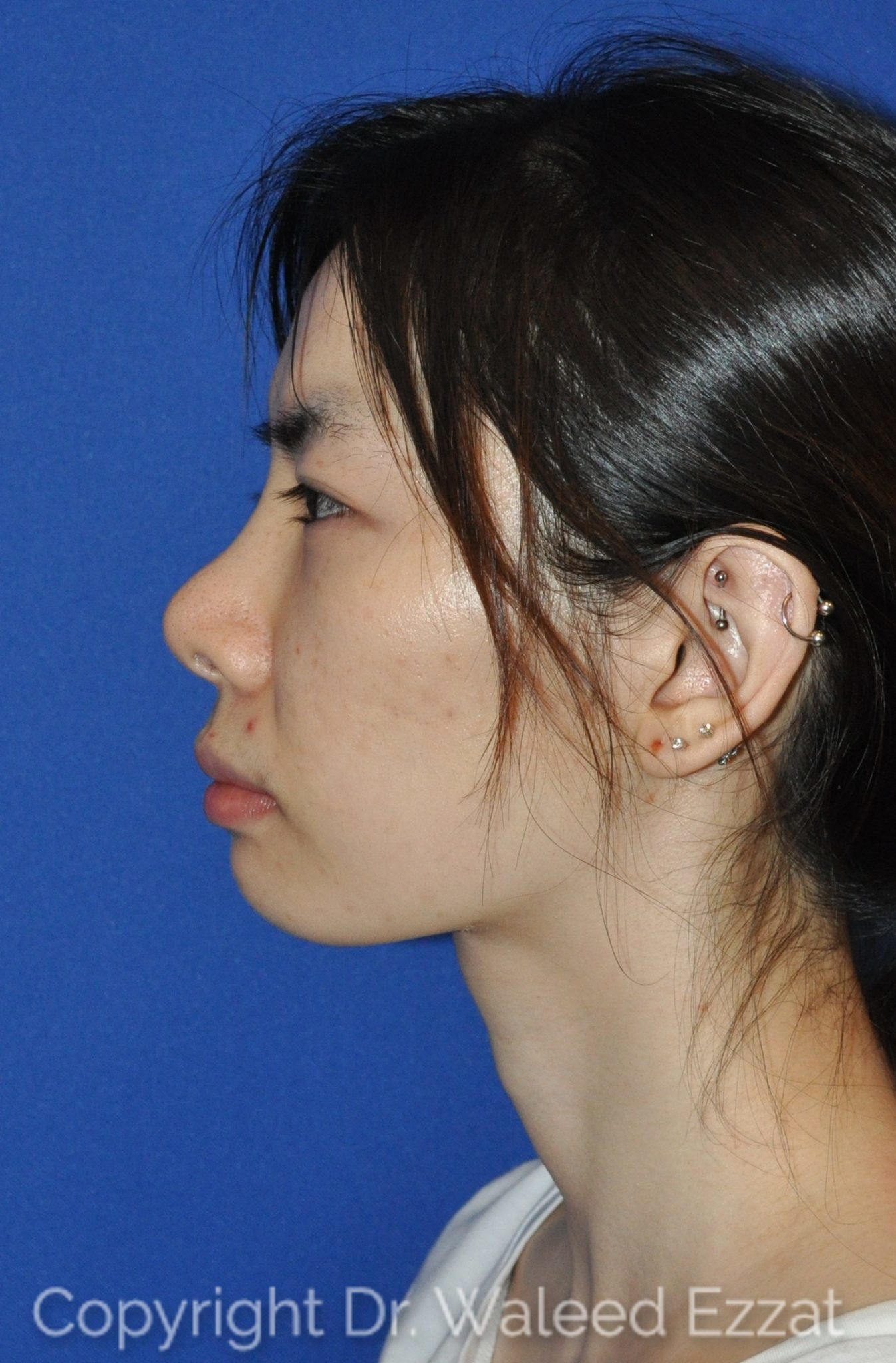 East Asian Rhinoplasty Patient Photo - Case 951 - before view-0