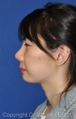Asian Rhinoplasty - Case 951 - After