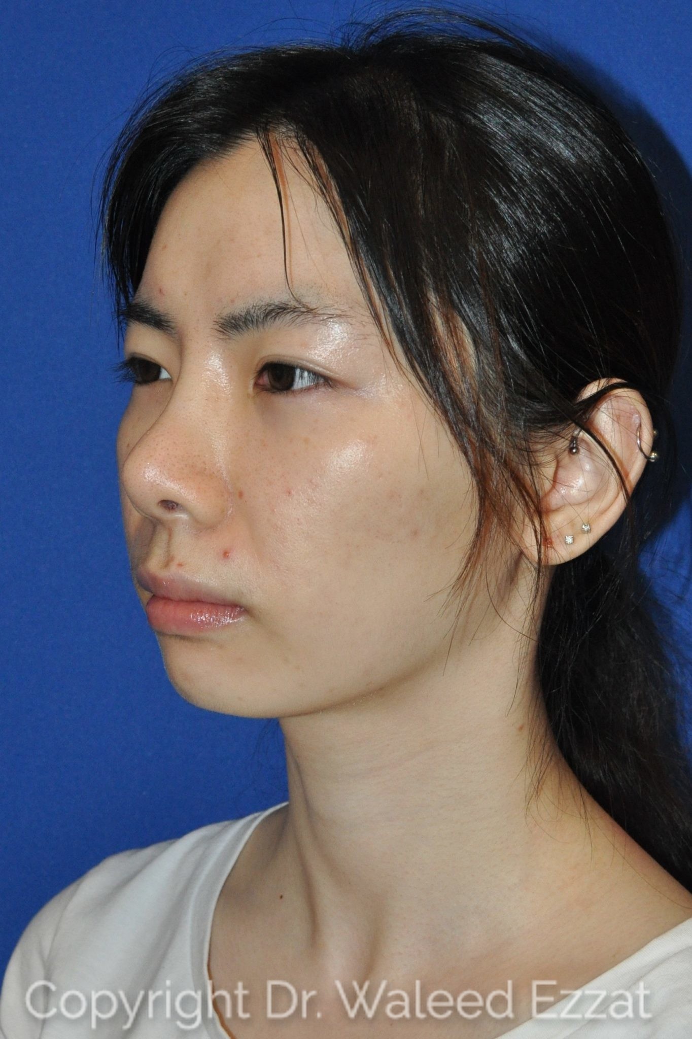 East Asian Rhinoplasty Patient Photo - Case 951 - before view-1