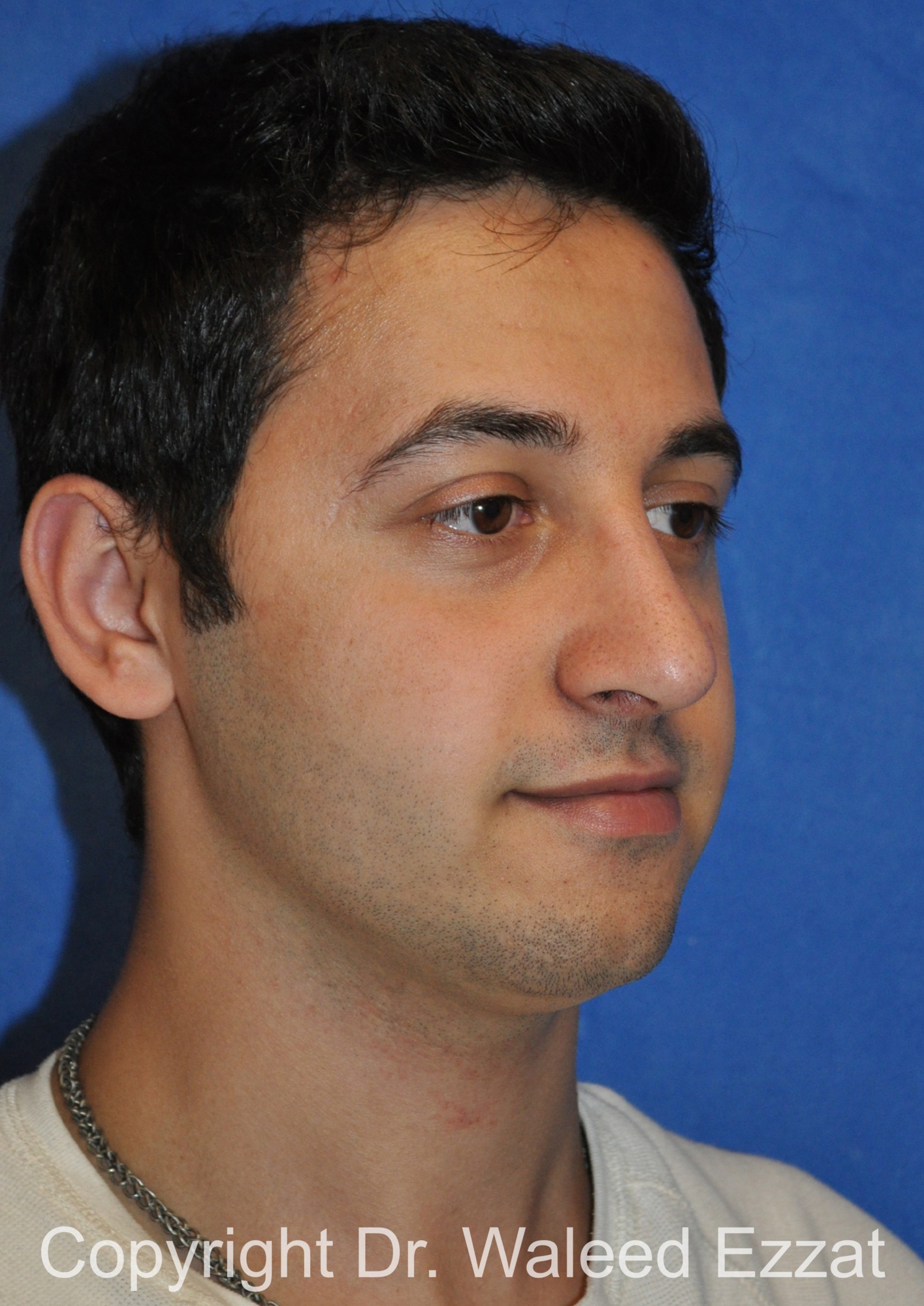 Male Rhinoplasty Patient Photo - Case 60 - after view-1