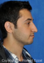 Male Rhinoplasty - Case 60 - Before