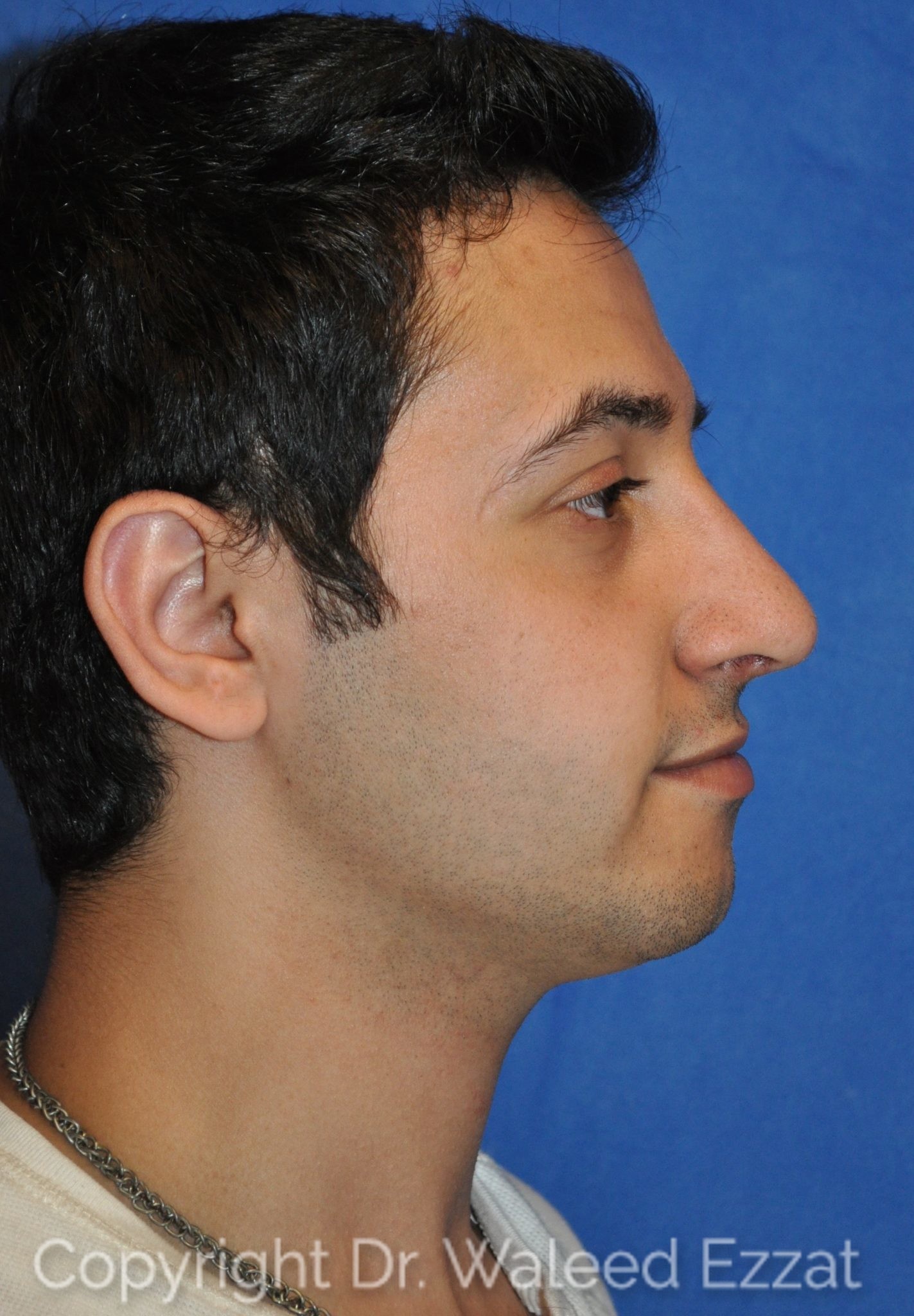 Male Rhinoplasty Patient Photo - Case 28 - after view