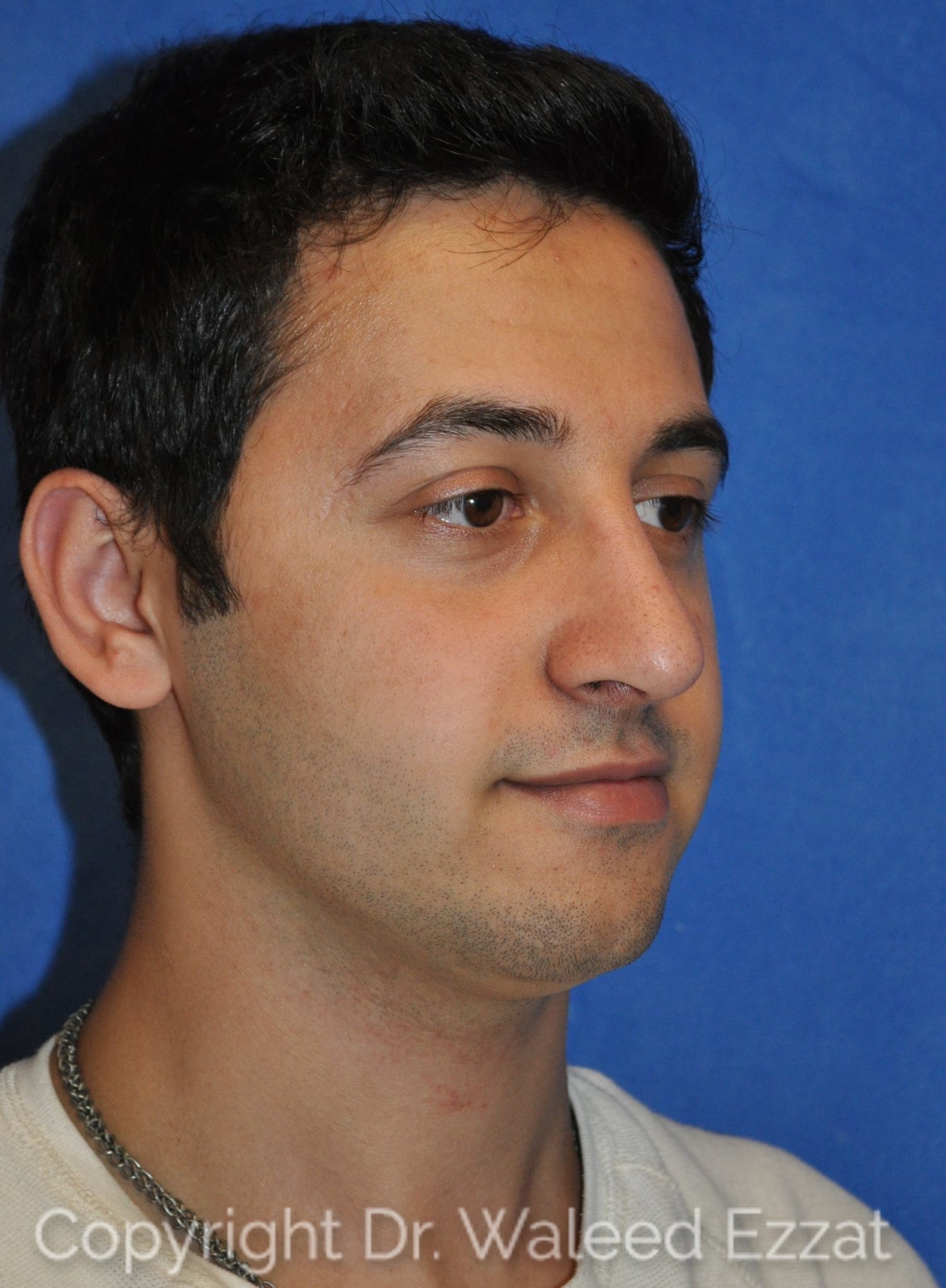 Male Rhinoplasty Patient Photo - Case 28 - after view-1