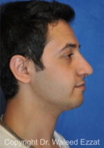 Male Rhinoplasty - Case 60 - After