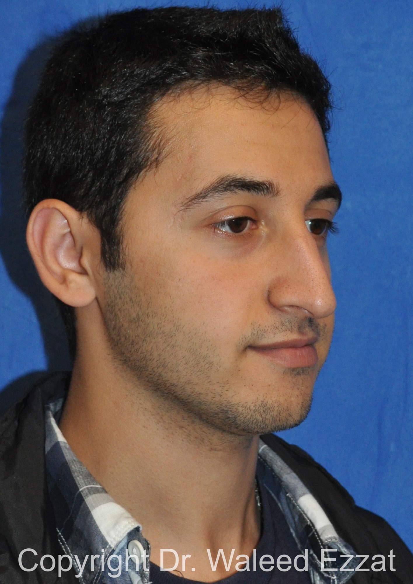 Male Rhinoplasty Patient Photo - Case 60 - before view-1