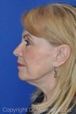 Caucasian/European Rhinoplasty - Case 111 - After