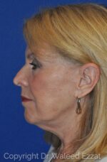 Caucasian/European Rhinoplasty - Case 111 - Before