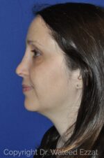 Caucasian/European Rhinoplasty - Case 112 - After
