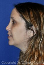 Caucasian/European Rhinoplasty - Case 112 - Before