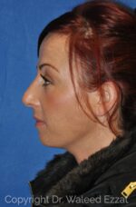 Caucasian/European Rhinoplasty - Case 113 - Before