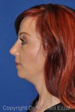 Revision Rhinoplasty - Case 113 - After