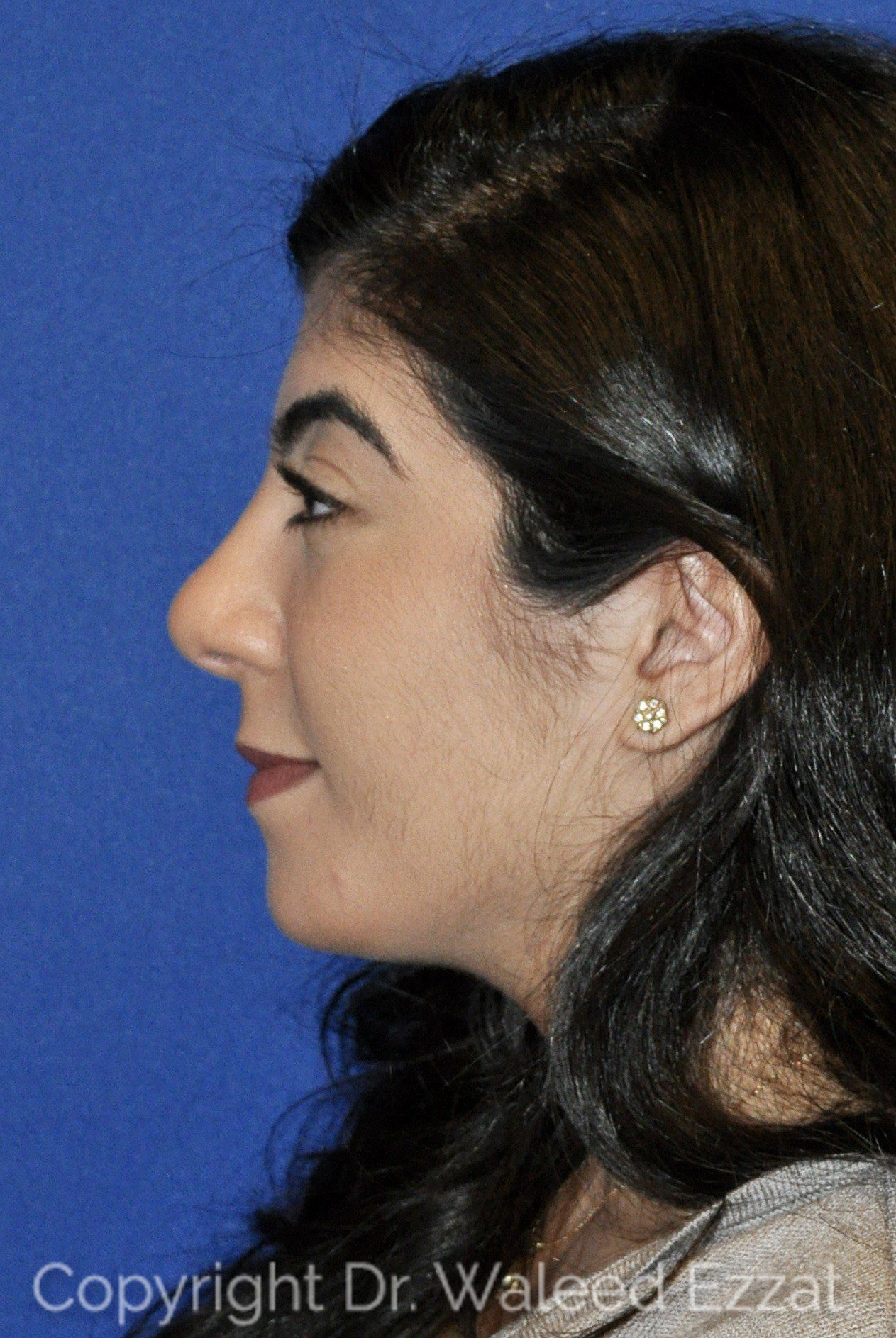 Mediterranean/Middle Eastern Rhinoplasty Patient Photo - Case 20 - after view-0