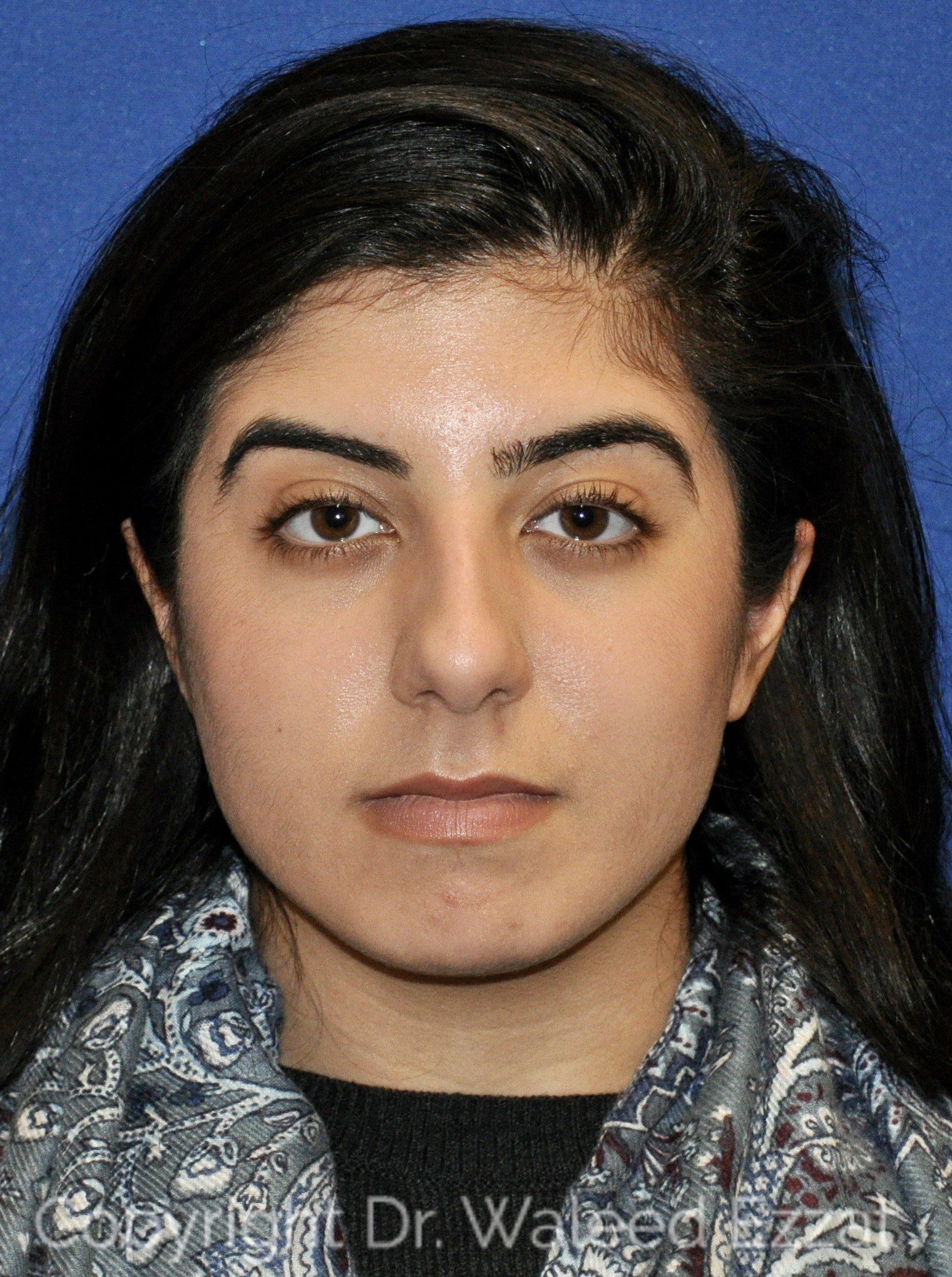 Mediterranean/Middle Eastern Rhinoplasty Patient Photo - Case 20 - before view-2