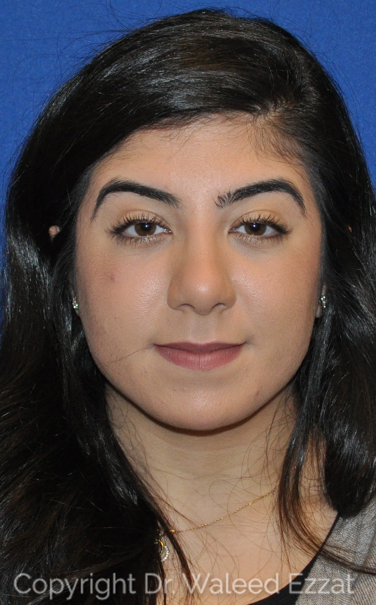 Mediterranean/Middle Eastern Rhinoplasty Patient Photo - Case 20 - after view-2