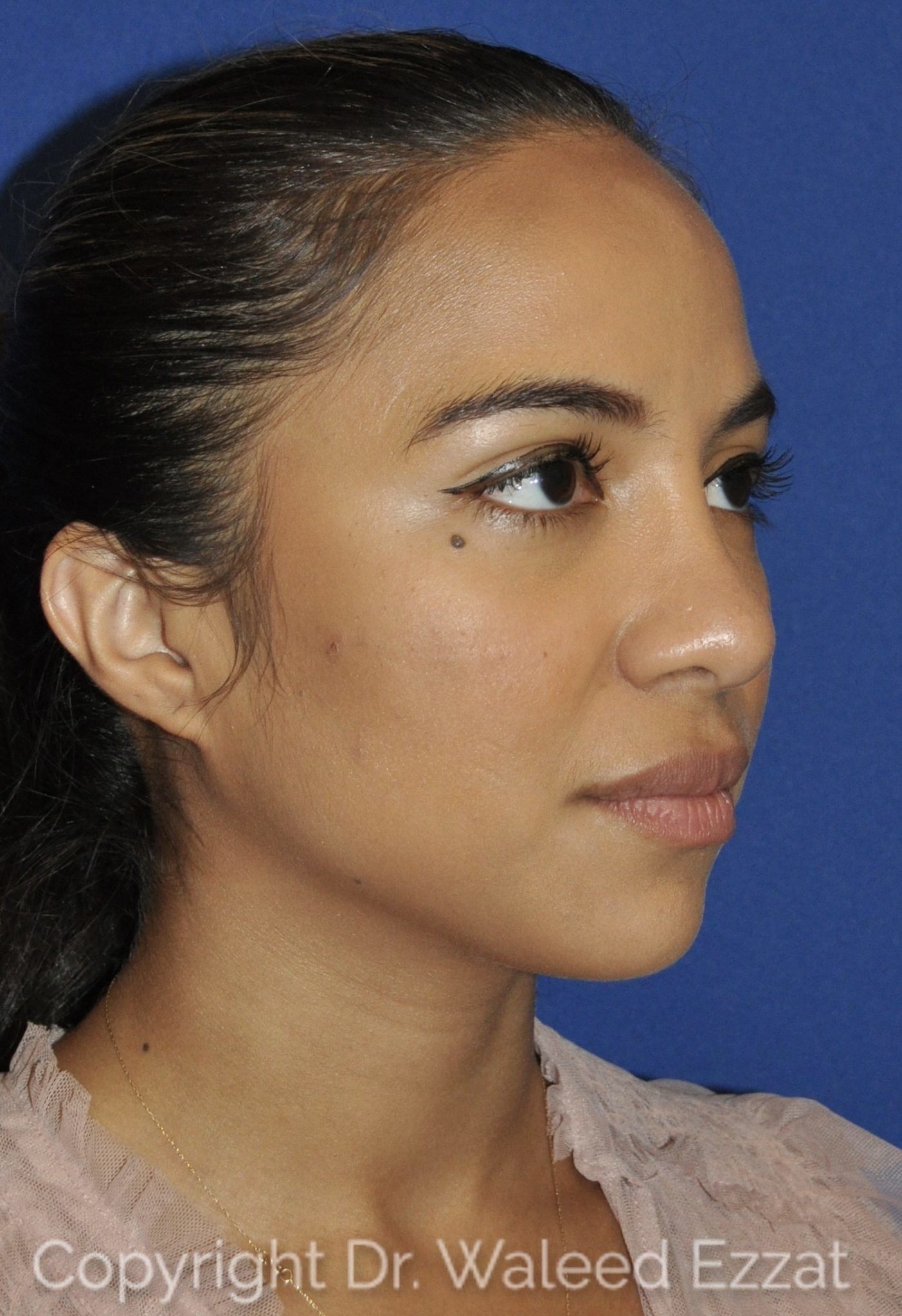 Hispanic/South American Rhinoplasty Patient Photo - Case 21-2 - after view-1