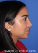 Hispanic/South American Rhinoplasty - Case 292 - After