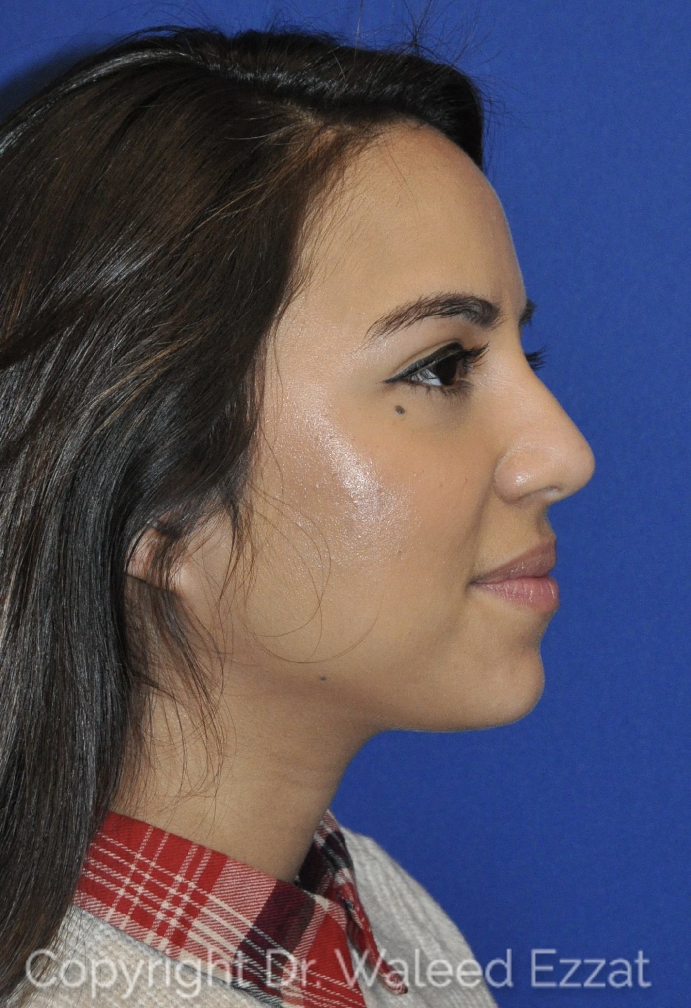 Hispanic/South American Rhinoplasty Patient Photo - Case 21-2 - before view-