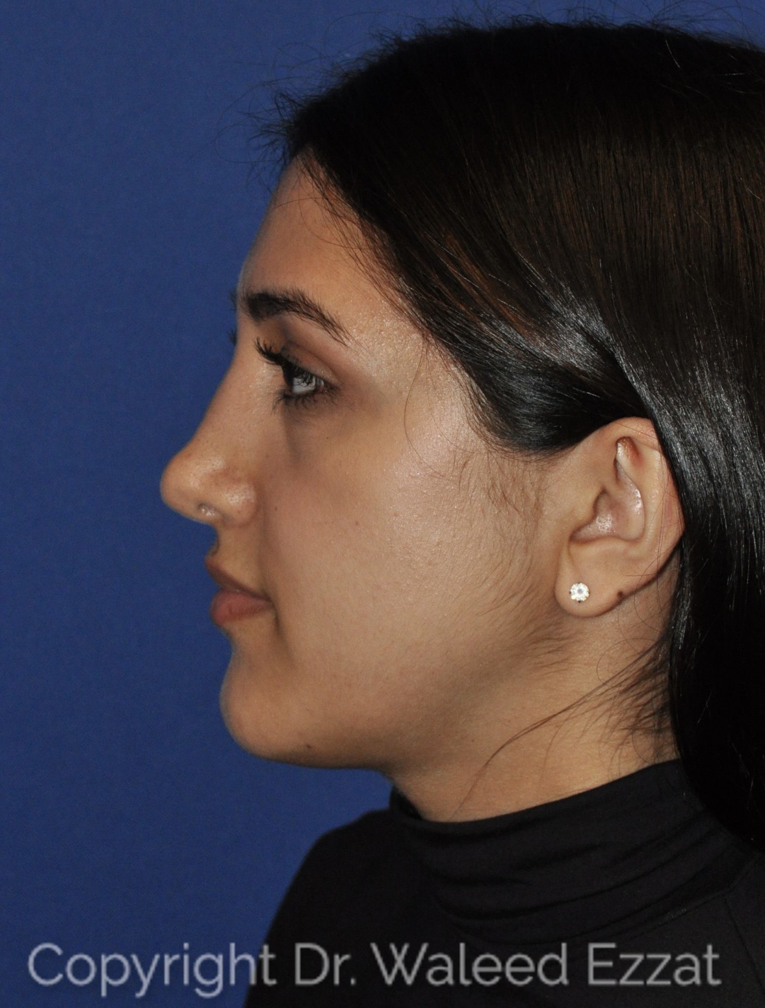 Mediterranean/Middle Eastern Rhinoplasty Patient Photo - Case 114 - before view-