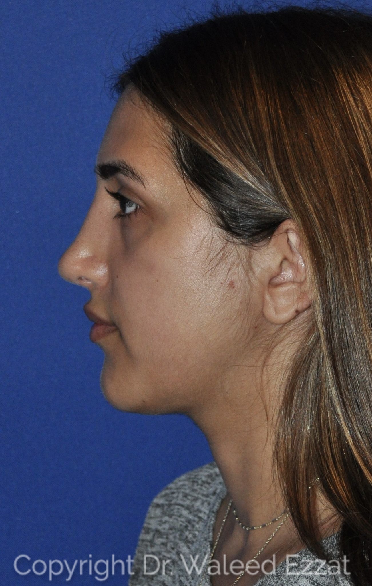 Mediterranean/Middle Eastern Rhinoplasty Patient Photo - Case 114 - after view