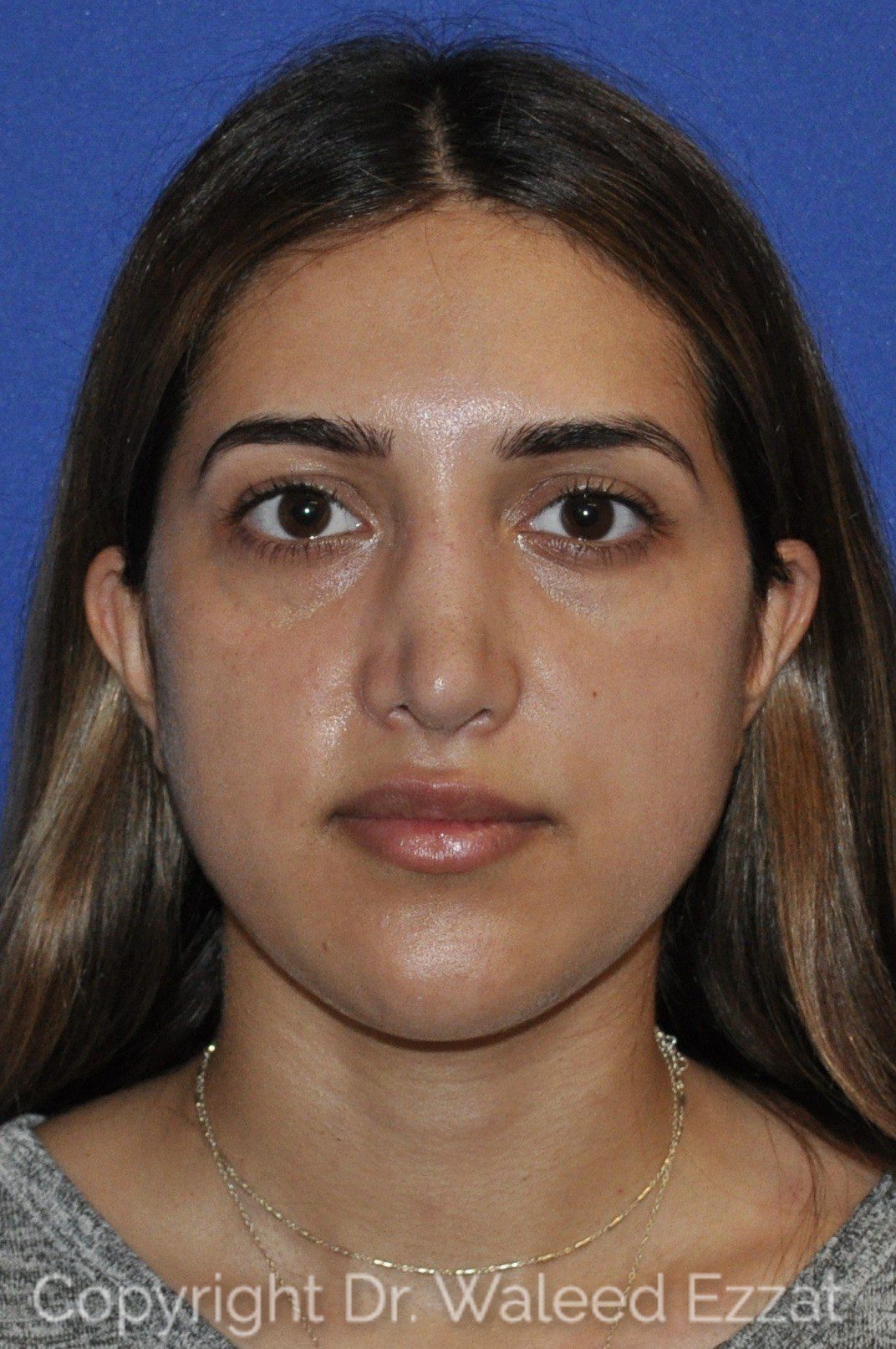 Mediterranean/Middle Eastern Rhinoplasty Patient Photo - Case 114 - after view-2