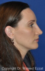 Caucasian/European Rhinoplasty - Case 340 - After