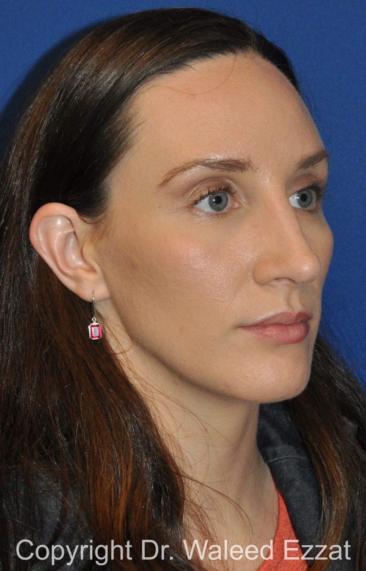 Rhinoplasty Patient Photo - Case 340 - after view-1