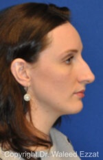 Caucasian/European Rhinoplasty - Case 340 - Before
