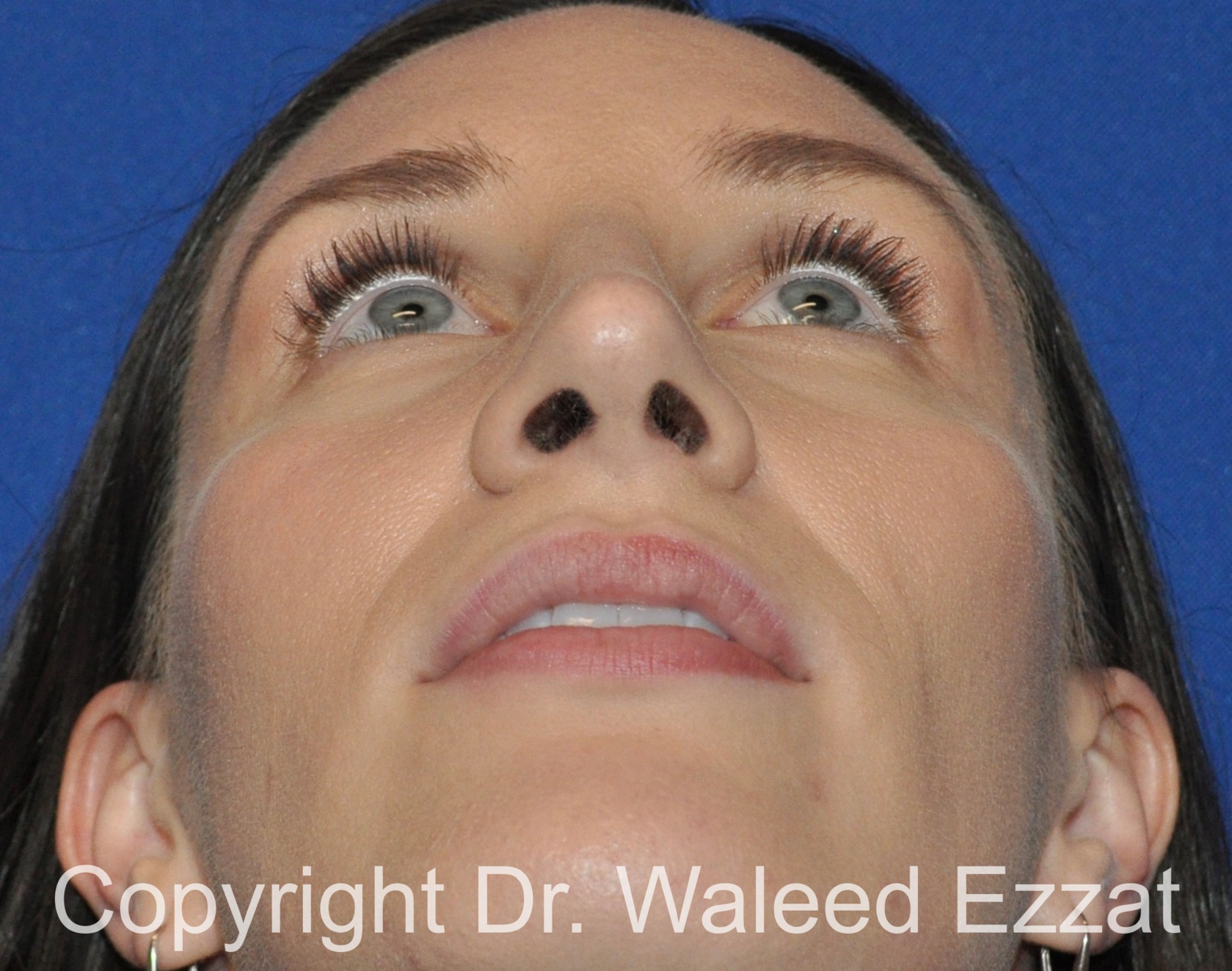 Rhinoplasty Patient Photo - Case 340 - after view-3