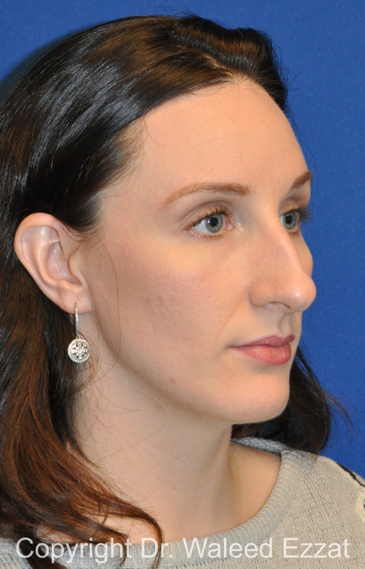 Rhinoplasty Patient Photo - Case 340 - before view-1
