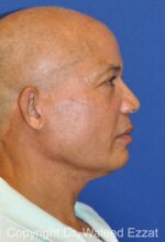 Brow Lift - Case 3 - After