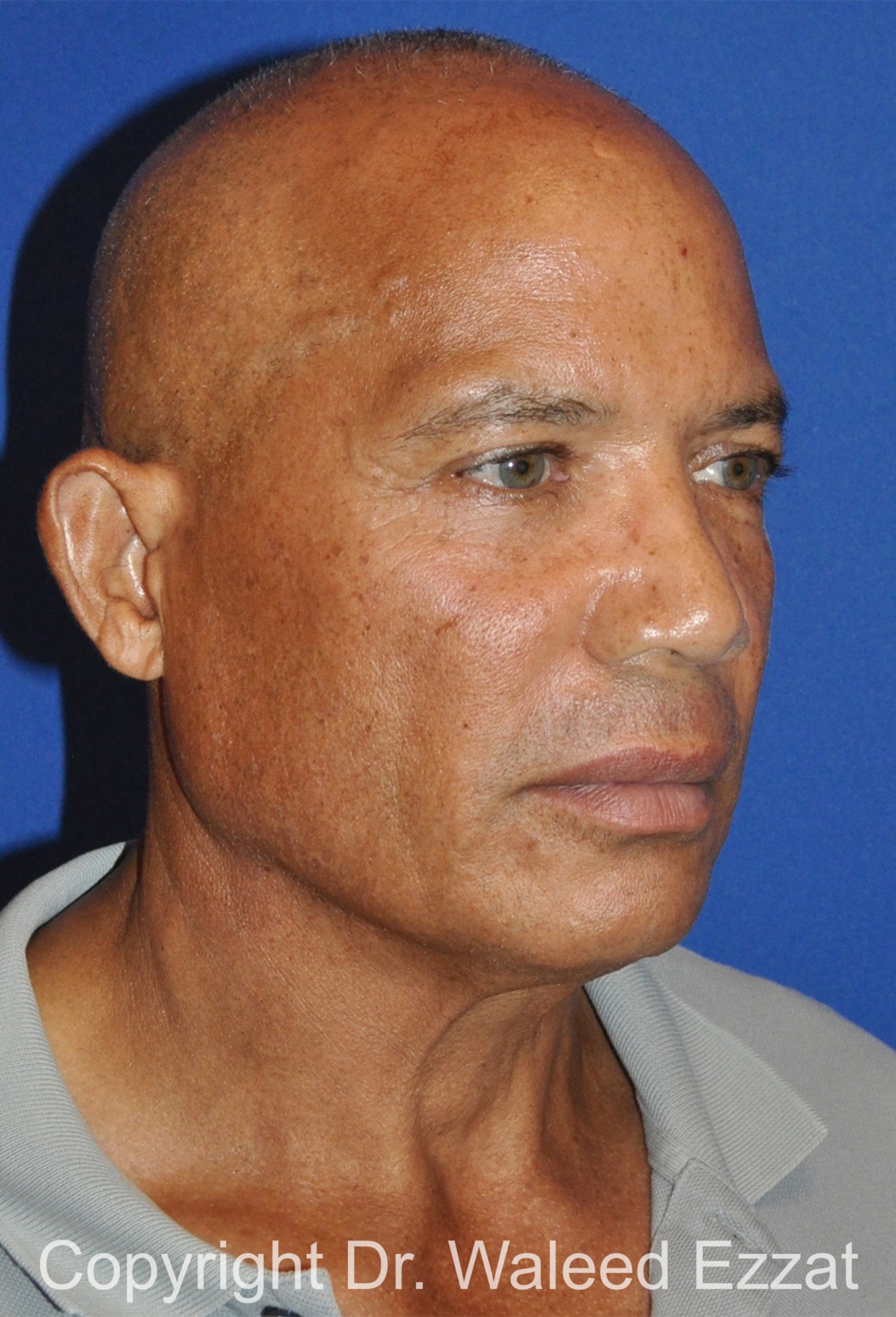 Facelift Patient Photo - Case 3 - before view-1