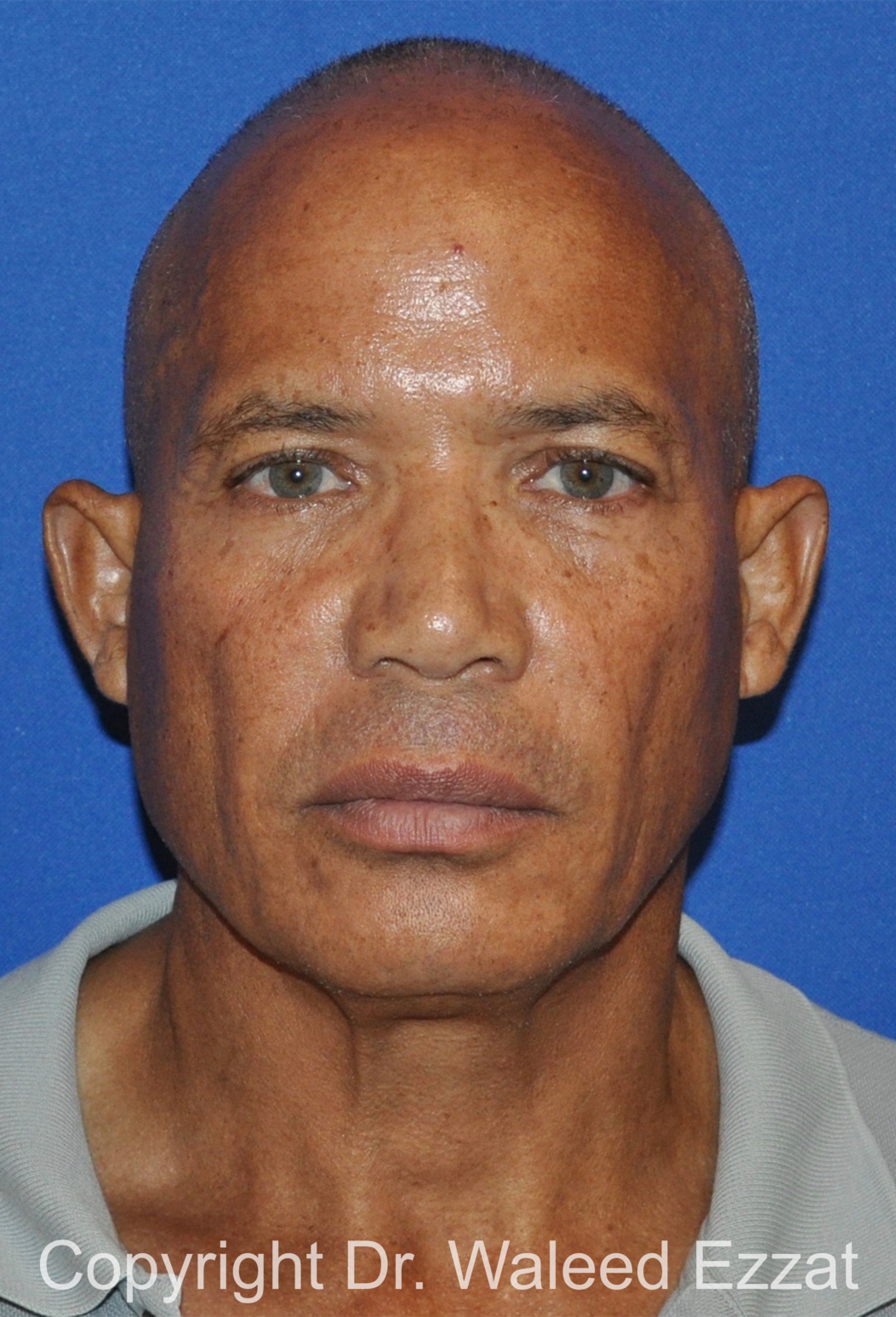 Facelift Patient Photo - Case 3 - before view-2