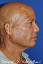 Brow Lift - Case 3 - Before