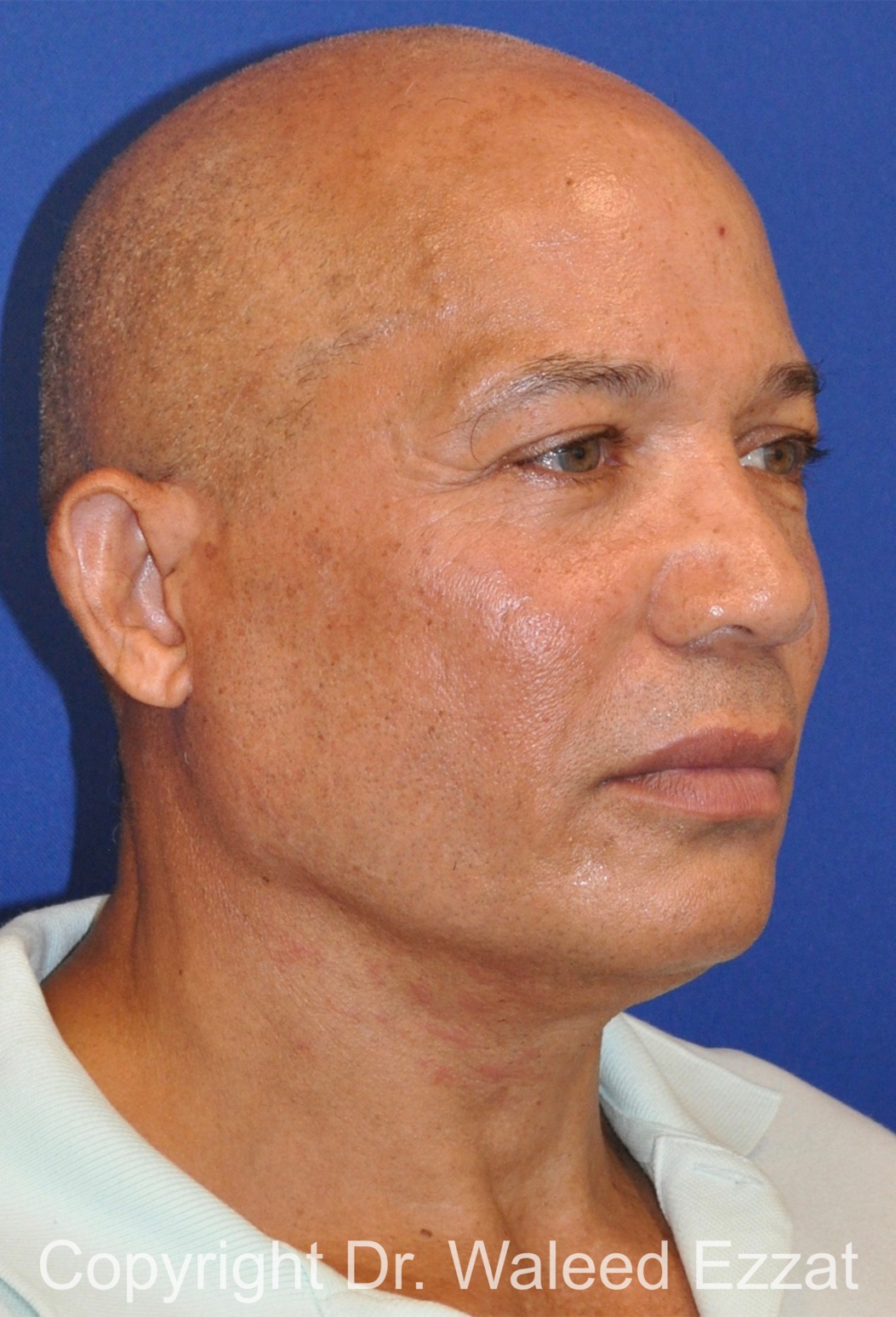 Facelift Patient Photo - Case 3 - after view-1