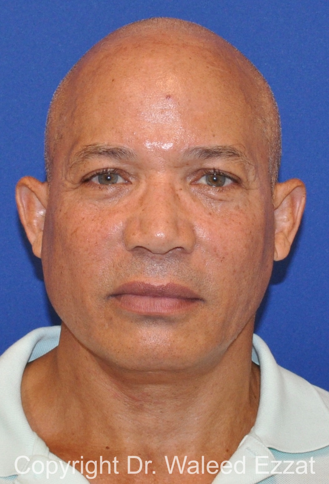 Facelift Patient Photo - Case 3 - after view-2