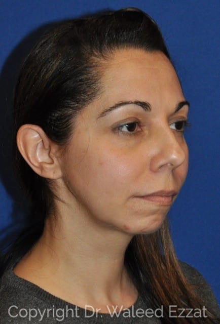 Mediterranean/Middle Eastern Rhinoplasty Patient Photo - Case 44-3 - before view-2