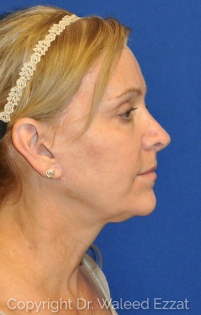 Blepharoplasty Patient Photo - Case 4-A - after view-0
