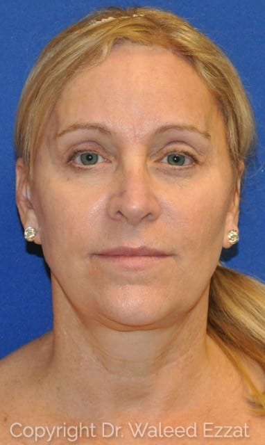 Blepharoplasty Patient Photo - Case 4-A - after view-1